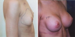 Breast Augmentation Patient Before & After Photo 1