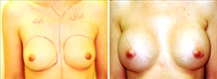 Breast Augmentation Patient Before & After Photo 1