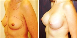 Breast Augmentation Patient Before & After Photo 1