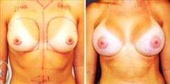 Breast Augmentation Patient Before & After Photo 1