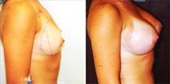 Breast Augmentation Patient Before & After Photo 1