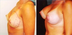 Breast Augmentation Patient Before & After Photo 1