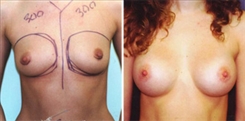 Breast Augmentation Patient Before & After Photo 1