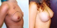 Breast Augmentation Patient Before & After Photo 1