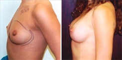 Breast Augmentation Patient Before & After Photo 1