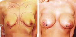 Breast Augmentation Patient Before & After Photo 1