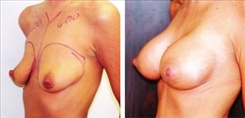 Breast Augmentation Patient Before & After Photo 1