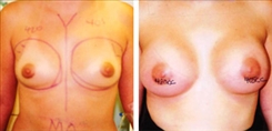 Breast Augmentation Patient Before & After Photo 1