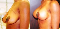 Breast Augmentation Patient Before & After Photo 1