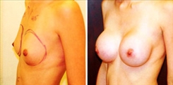 Breast Augmentation Patient Before & After Photo 1