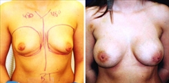 Breast Augmentation Patient Before & After Photo 1