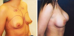 Breast Augmentation Patient Before & After Photo 1