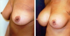 Breast Augmentation Patient Before & After Photo 1