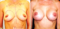 Breast Augmentation Patient Before & After Photo 1