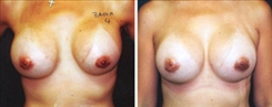 Breast Augmentation Patient Before & After Photo 1