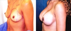 Breast Augmentation Patient Before & After Photo 1