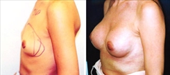 Breast Augmentation Patient Before & After Photo 1