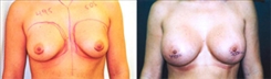 Breast Augmentation Patient Before & After Photo 1