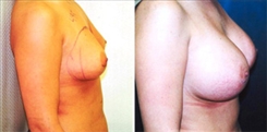 Breast Augmentation Patient Before & After Photo 1