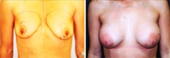 Breast Augmentation Patient Before & After Photo 1