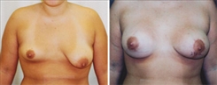 Breast Augmentation Patient Before & After Photo 1