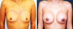 Breast Augmentation Patient Before & After Photo 1