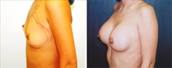 Breast Augmentation Patient Before & After Photo 1