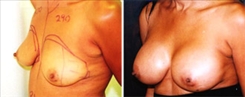 Breast Augmentation Patient Before & After Photo 1