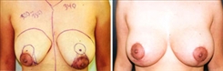 Breast Augmentation Patient Before & After Photo 1