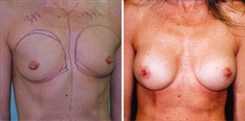 Breast Augmentation Patient Before & After Photo 1