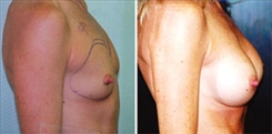 Breast Augmentation Patient Before & After Photo 1