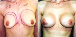 Breast Augmentation Patient Before & After Photo 1