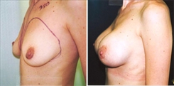 Breast Augmentation Patient Before & After Photo 1