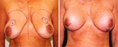 Breast Augmentation Patient Before & After Photo 1