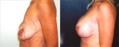 Breast Augmentation Patient Before & After Photo 1