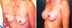 Breast Augmentation Patient Before & After Photo 1