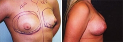 Breast Augmentation Patient Before & After Photo 1