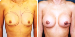 Breast Augmentation Patient Before & After Photo 1