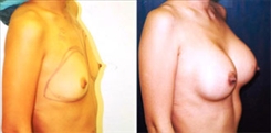 Breast Augmentation Patient Before & After Photo 1