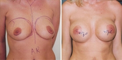 Breast Augmentation Patient Before & After Photo 1