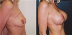 Breast Augmentation Patient Before & After Photo 1