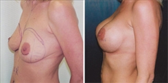 Breast Augmentation Patient Before & After Photo 1