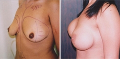 Breast Augmentation Patient Before & After Photo 1