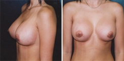 Breast Augmentation Patient Before & After Photo 1