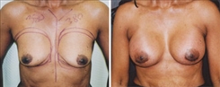 Breast Augmentation Patient Before & After Photo 1