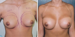 Breast Augmentation Patient Before & After Photo 1