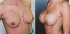 Breast Augmentation Patient Before & After Photo 1