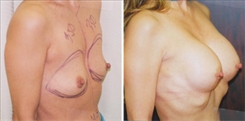 Breast Augmentation Patient Before & After Photo 1