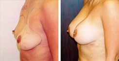 Breast Augmentation Patient Before & After Photo 1