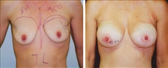 Breast Augmentation Patient Before & After Photo 1